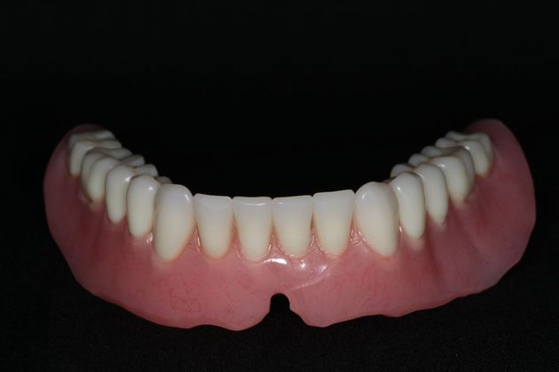 Dentures: Case 10 - Lower Denture