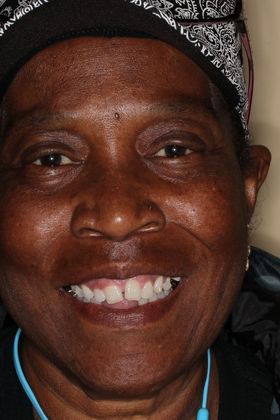 Veneers Case 21 - Before