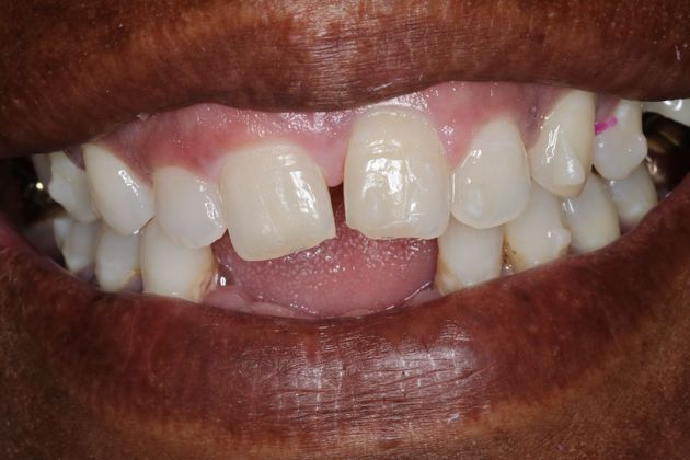 Veneers: Case 21 - Before