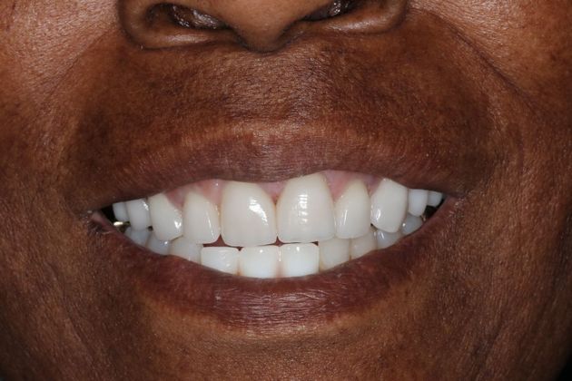 Veneers: Case 21 - After