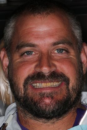 Full Mouth Reconstruction: Case 7 - After Braces