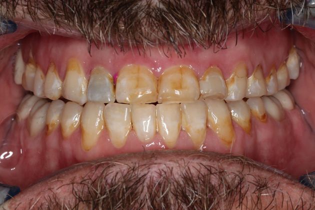 Full Mouth Reconstruction: Case 7 - After Braces 