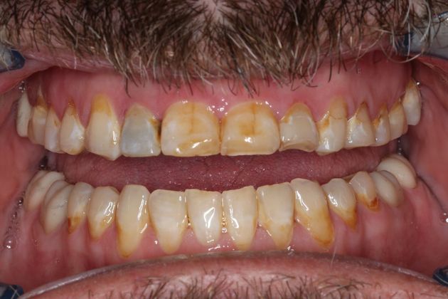 Full Mouth Reconstruction: Case 7 - After Braces