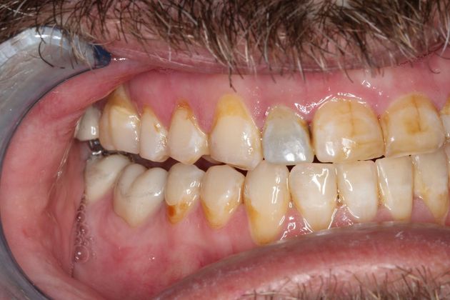 Full Mouth Reconstruction: Case 7 - After Braces