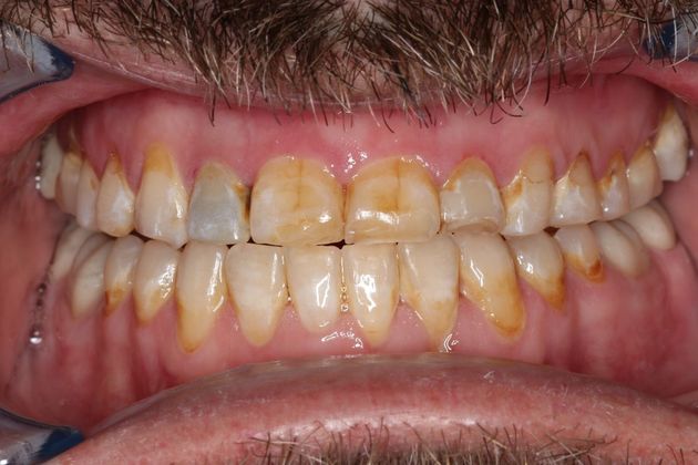 Full Mouth Reconstruction: Case 7 - After Braces