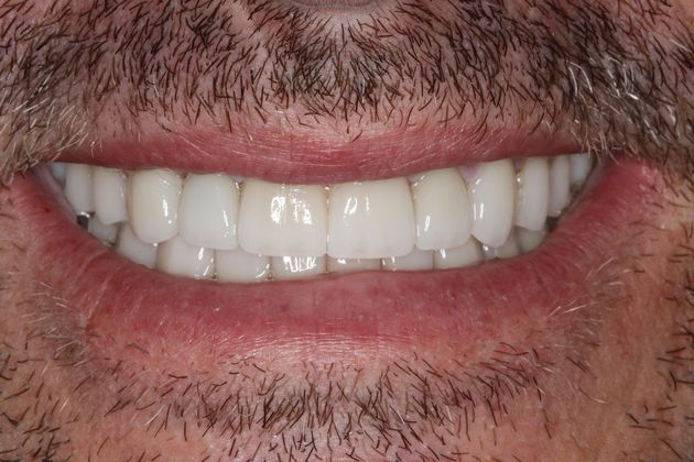 Full Mouth Reconstruction: Case 7 - After