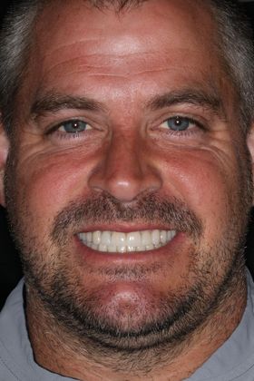 Full Mouth Reconstruction: Case 7 - After