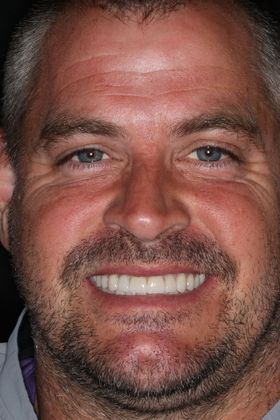 Full Mouth Reconstruction Case 7 - After