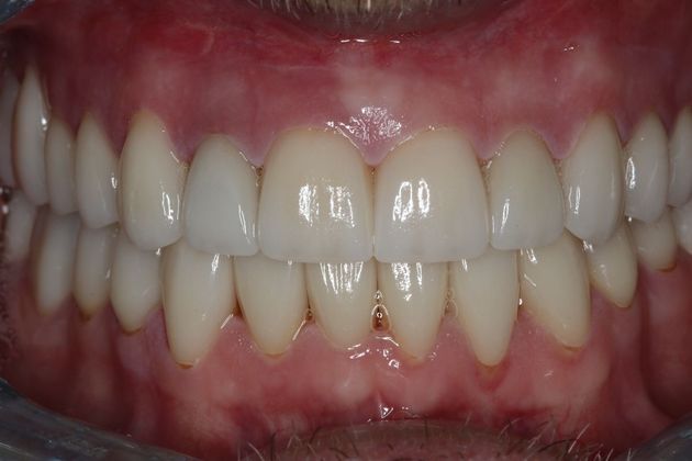 Full Mouth Reconstruction: Case 7 - After