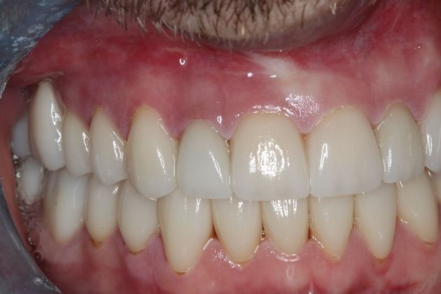 Full Mouth Reconstruction: Case 7 - After