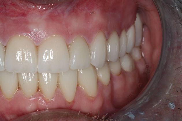 Full Mouth Reconstruction: Case 7 - After