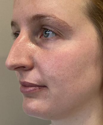 Rhinoplasty: Case 32 Rhinoplasty Scarsdale, NY - Before