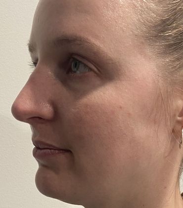 Rhinoplasty: Case 32 Rhinoplasty Scarsdale, NY - After