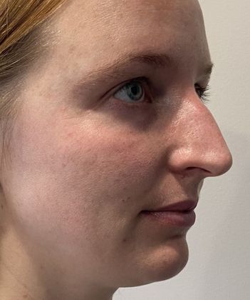 Rhinoplasty: Case 32 Rhinoplasty Scarsdale, NY - Before