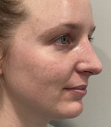 Rhinoplasty: Case 32 Rhinoplasty Scarsdale, NY - After