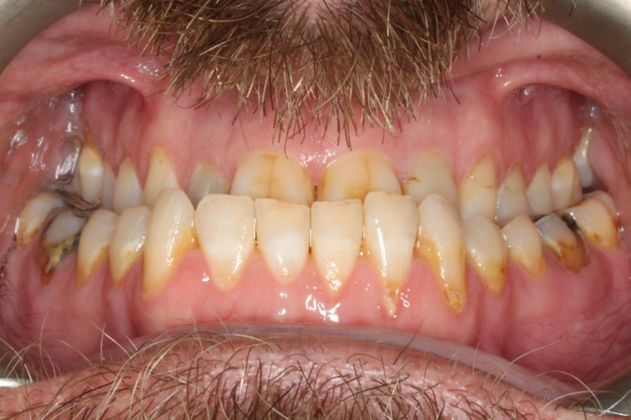 Full Mouth Reconstruction: Case 7 - Before