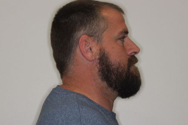 Full Mouth Reconstruction: Case 7 - Before