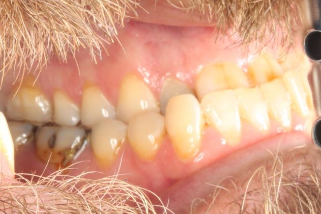 Full Mouth Reconstruction: Case 7 - Before