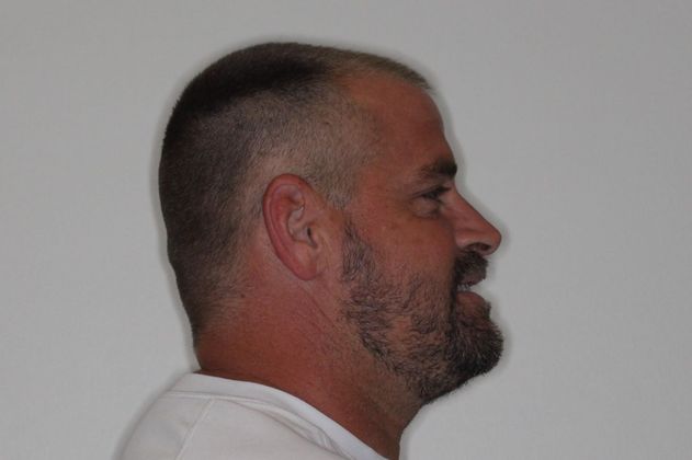 Full Mouth Reconstruction: Case 7 - After Braces 