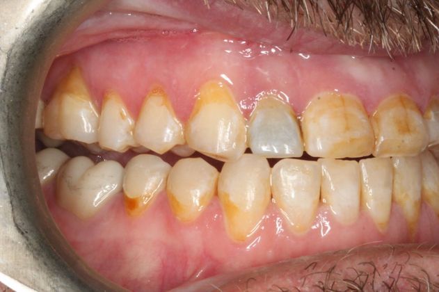 Full Mouth Reconstruction: Case 7 - After