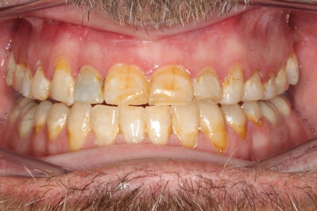 Full Mouth Reconstruction: Case 7 - After Braces