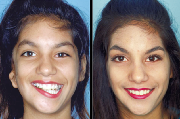 Facial Symmetry Cases