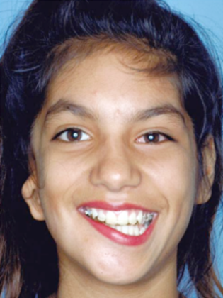 Facial Symmetry  Before & After - Before