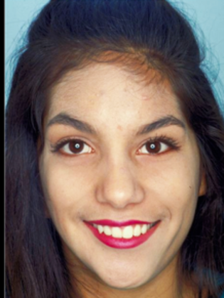 Facial Symmetry  Before & After - After