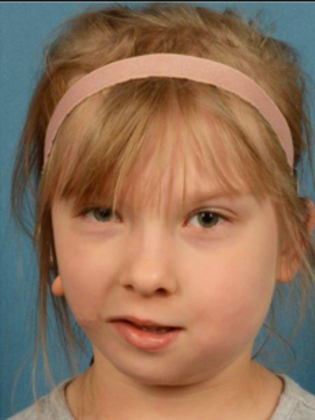 Facial Symmetry  Case 2 - Before