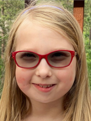 Facial Symmetry  Case 2 - After