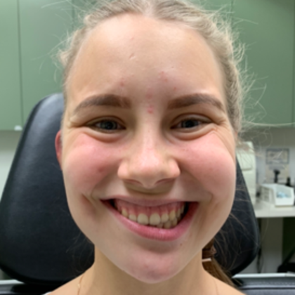 Facial Symmetry  Case 3 - Before