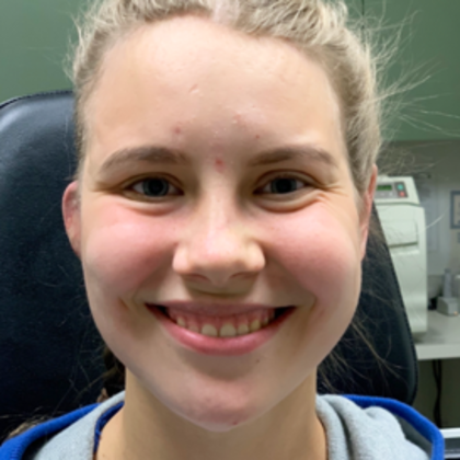 Facial Symmetry  Case 3 - After