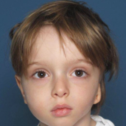 Facial Symmetry  Case 4 - Before