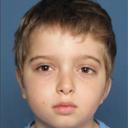 Facial Symmetry  Case 4 - After