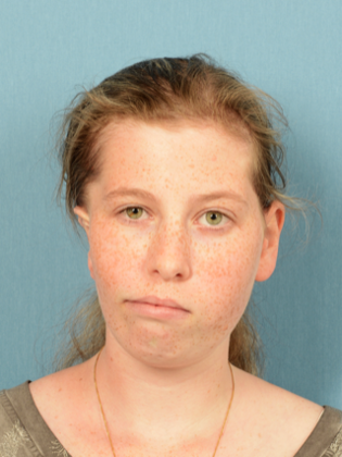 Facial Symmetry  Case 5 - Before