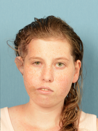 Facial Symmetry  Case 5 - After