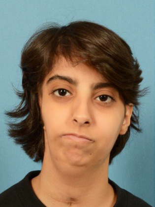 Facial Symmetry  Case 6 - Before