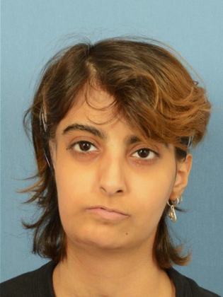 Facial Symmetry  Case 6 - After