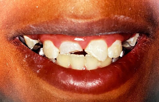 Before and After Gallery Case 12 Bonding  - Before