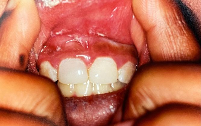 Before and After Gallery Case 12 Bonding  - After