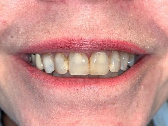 Smile Makeovers: Case 5 - Before