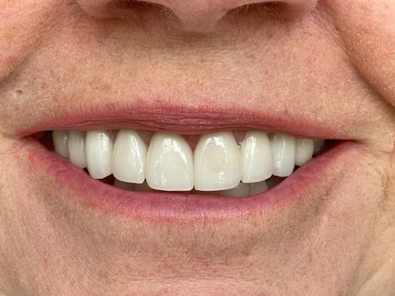 Case 5 Smile Makeovers Before And After Gallery