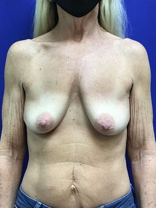 Breast Lift / Mastopexy Case 39 (31680) - Before