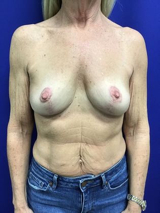 Breast Lift / Mastopexy Case 39 (31680) - After