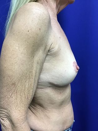 Breast Lift / Mastopexy: Case 39 (31680) - After