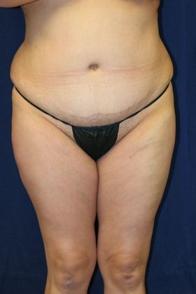 Brazilian Butt Lift : Case 12 - Before