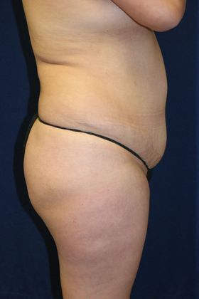 Brazilian Butt Lift : Case 12 - Before