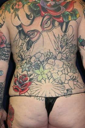 Liposuction & Safe Lipo Case 47 - After