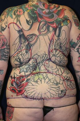 Liposuction & Safe Lipo Case 47 - Before