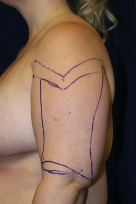 Arm Lift*/Arm Sculpting: Case 14 - Before